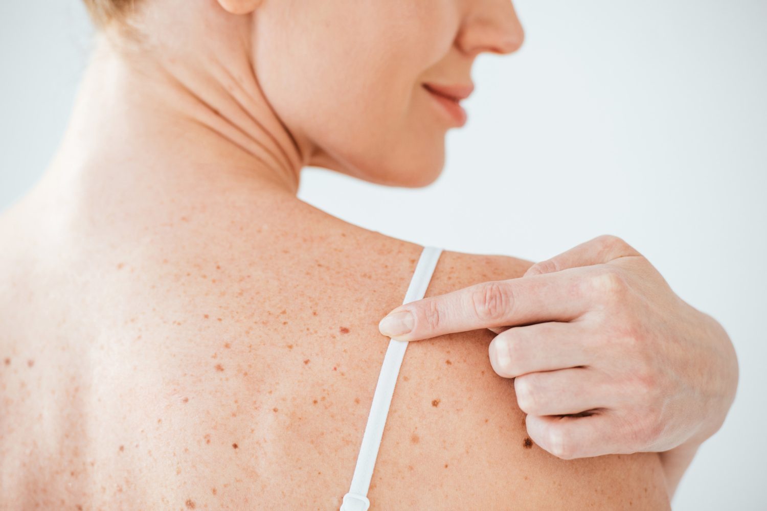 Eine Frau mit Sommersprossen auf der Schulter, die sich einer SkinScreener-Untersuchung unterzieht.